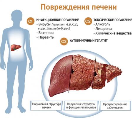 Заболевания печени - причины, симптомы