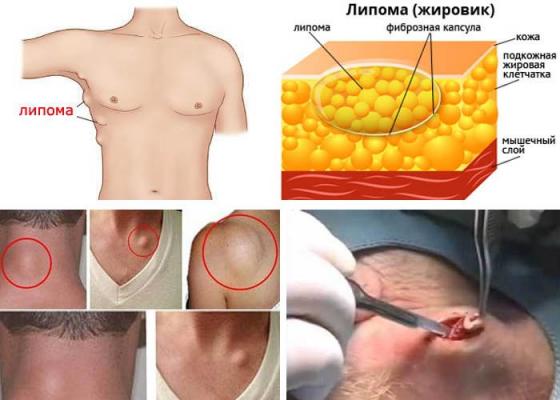 Когда случаются проблемы со здоровьем? Лечение липомы