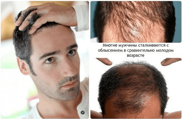 Помогают ли шампуни от облысения у мужчин?