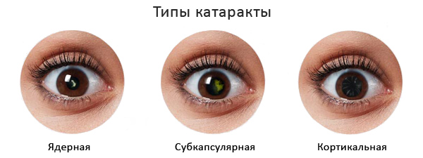 Лечение катаракты в Москве