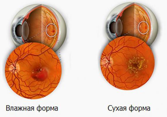 Проблемы со зрением. Макулодистрофия