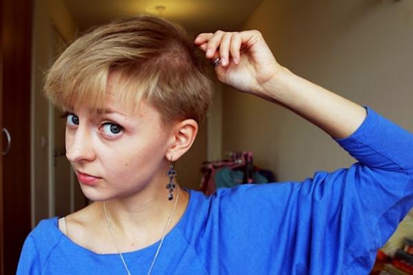 Трихотилломания: что это такое и как с ней бороться?