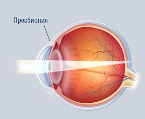 Пресбиопия глаз у взрослых и как лечить