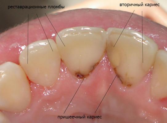 Лечение кариеса зубов в клинике «SDS Clinic»