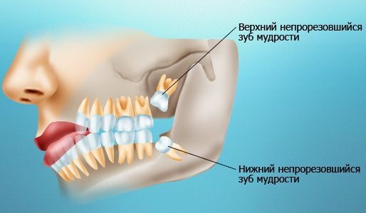 Удаление зуба мудрости